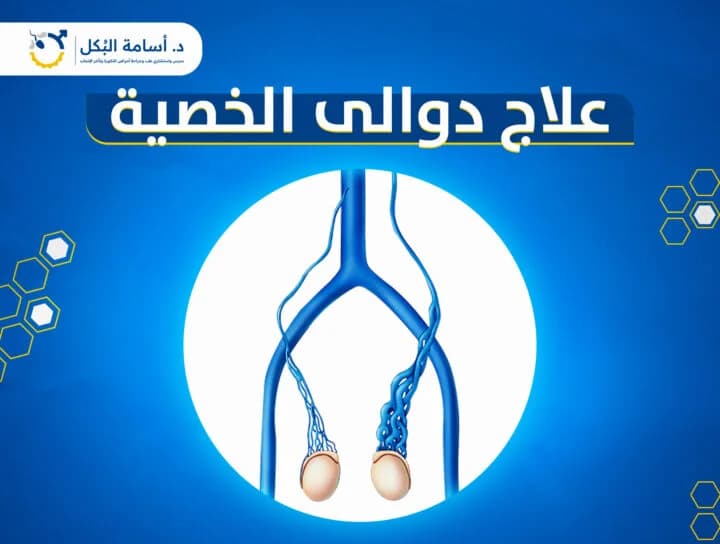 علاج دوالي الخصية