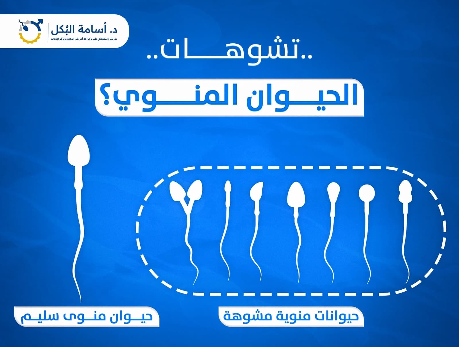 تكسير المادة الوراثية في الحيوانات المنوية والاجهاض المتكرر عند الزوجة