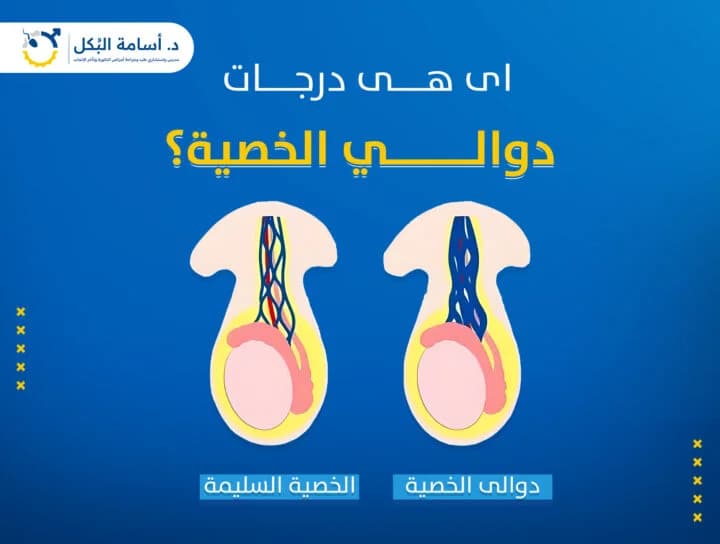 درجات دوالي الخصية وأشكالها