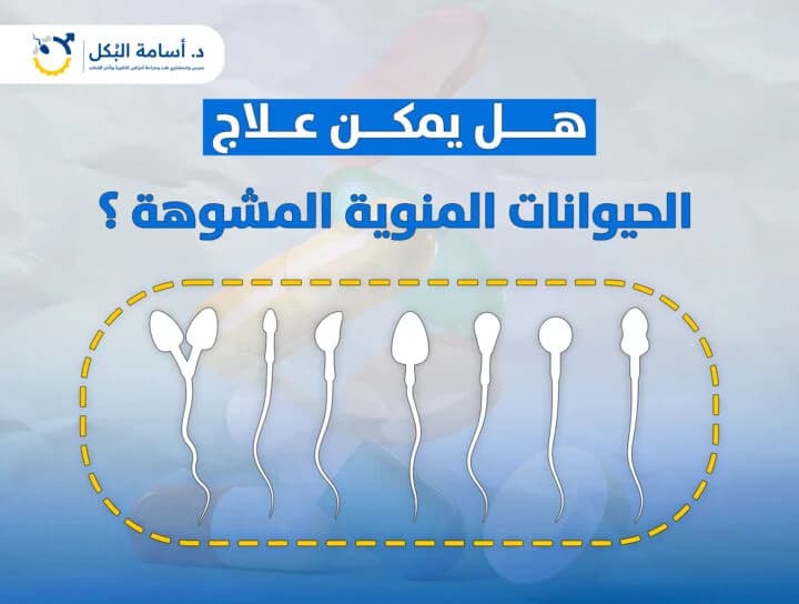 هل يمكن علاج الحيوانات المنوية المشوهة ؟