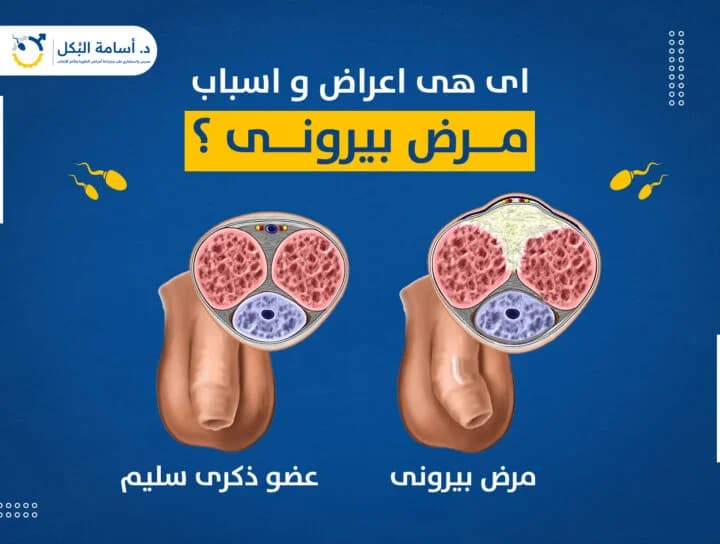 ما هي اعراض و اسباب مرض بيرونى ؟