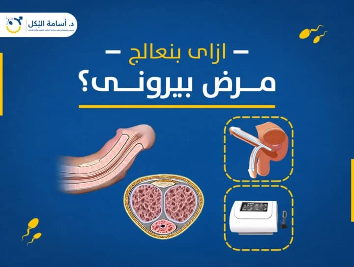 تشخيص وعلاج مرض بيروني