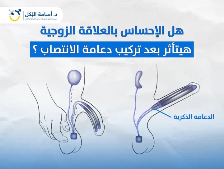 هل الإحساس بالعلاقة الزوجية هيتأثر بعد تركيب دعامة الانتصاب؟