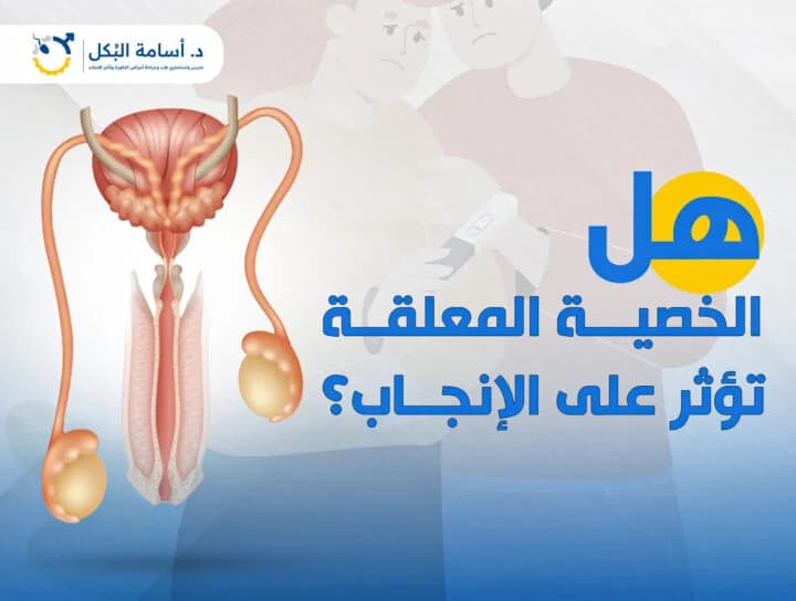 متى يسمح بالعلاقة الزوجية بعد عملية دوالي الخصية؟