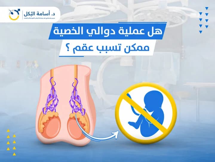 هل عملية دوالي الخصية ممكن تسبب عقم؟