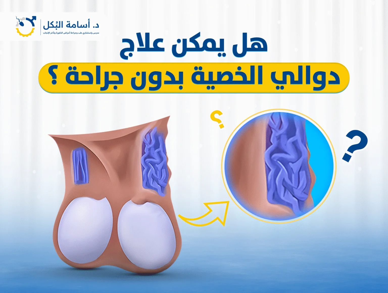 هل يمكن علاج دوالي الخصية بدون جراحة ؟