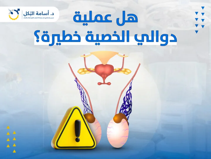 هل عملية دوالي الخصية خطيرة؟