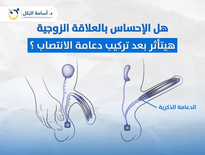 هل الإحساس بالعلاقة الزوجية هيتأثر بعد تركيب دعامة الانتصاب؟