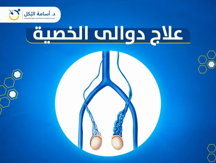 علاج دوالي الخصية