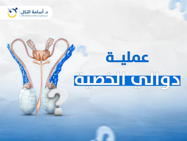 عملية دوالي الخصية
