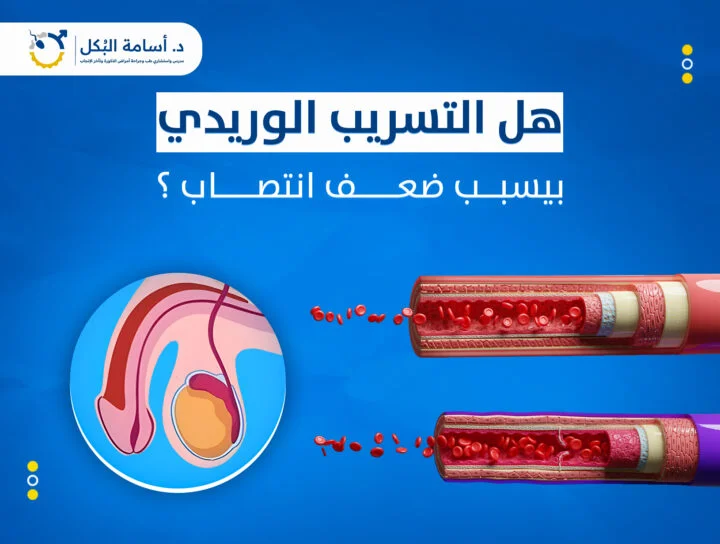 هل التسريب الوريدي بيسبب ضعف انتصاب؟