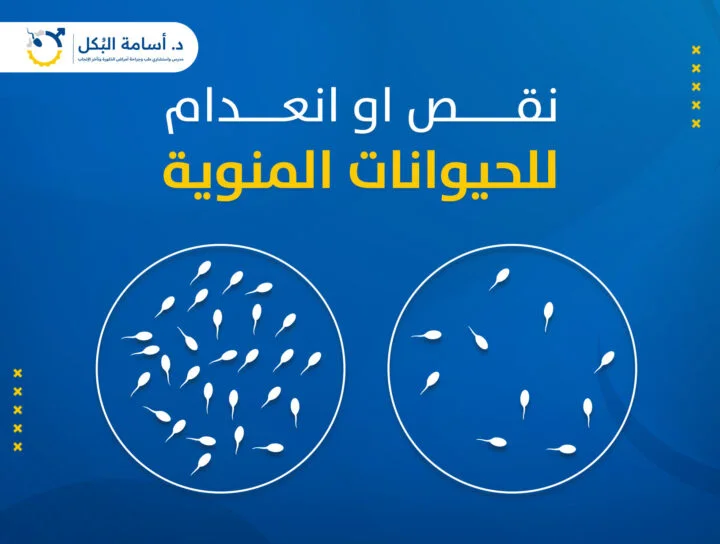 انعدام الحيوانات المنوية