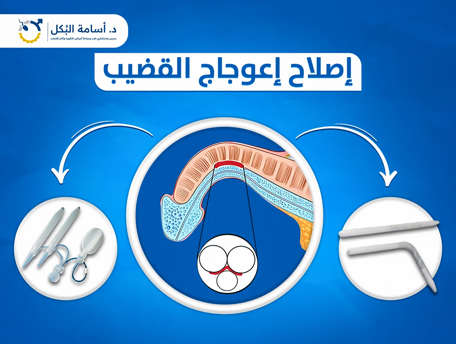 دعامات العضو الذكري
