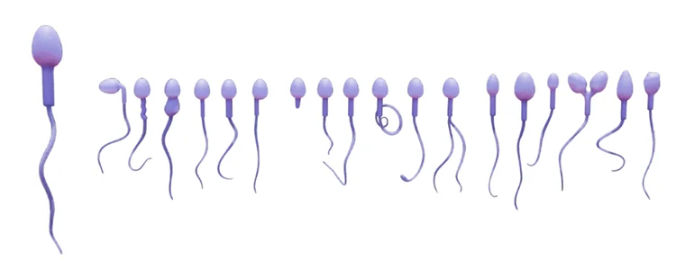 Sperm Abnormalities