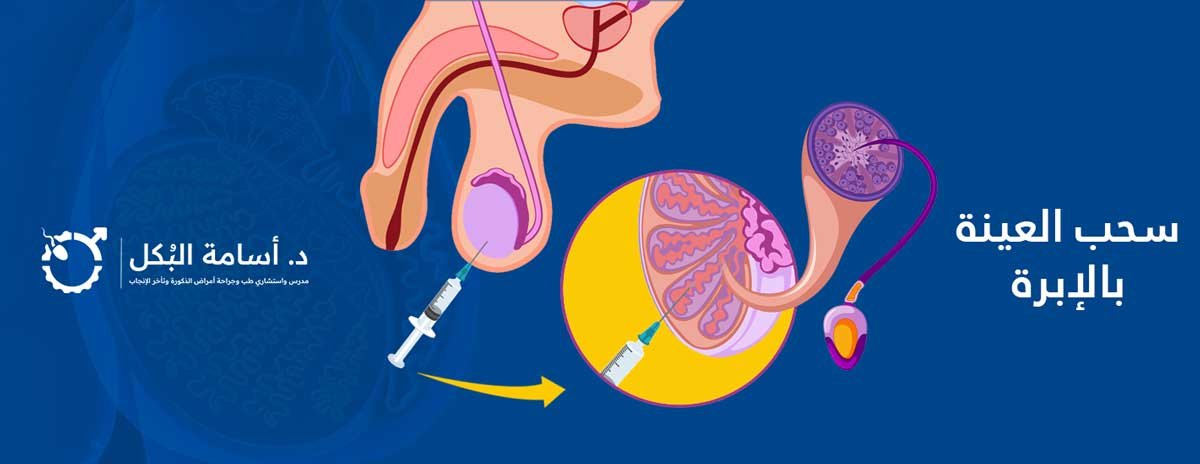 Surgical-sperm-retrieval, سحب العينة بالإبرة