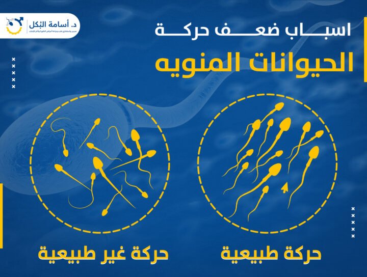 اسباب ضعف حركة الحيوانات المنوية ؟