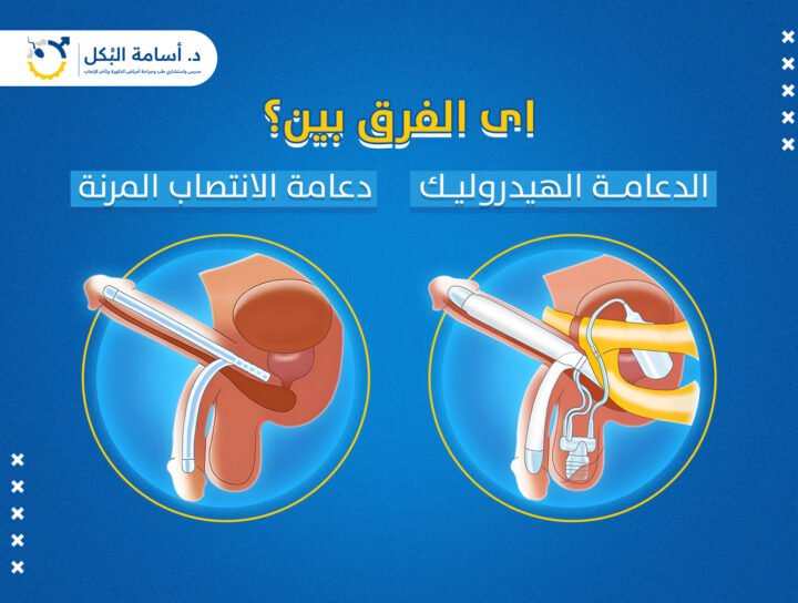 اى الفرق بين دعامة الانتصاب المرنة و الدعامة الهيدروليك