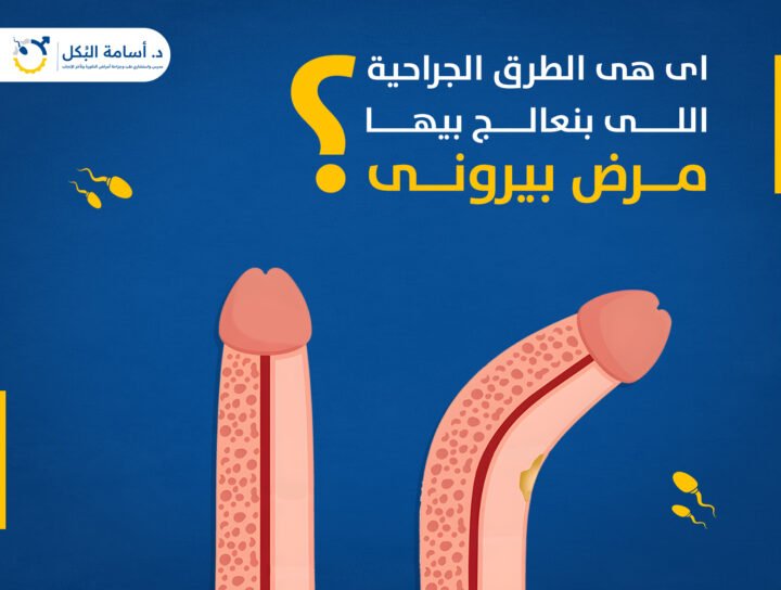  اى هى الطرق الجراحية اللى بنعالج بيها مرض بيرونى ؟ 