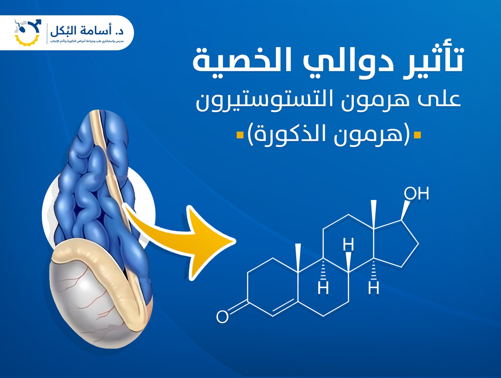 تأثير دوالي الخصية على هرمون التستوستيرون ( هرمون الذكورة )