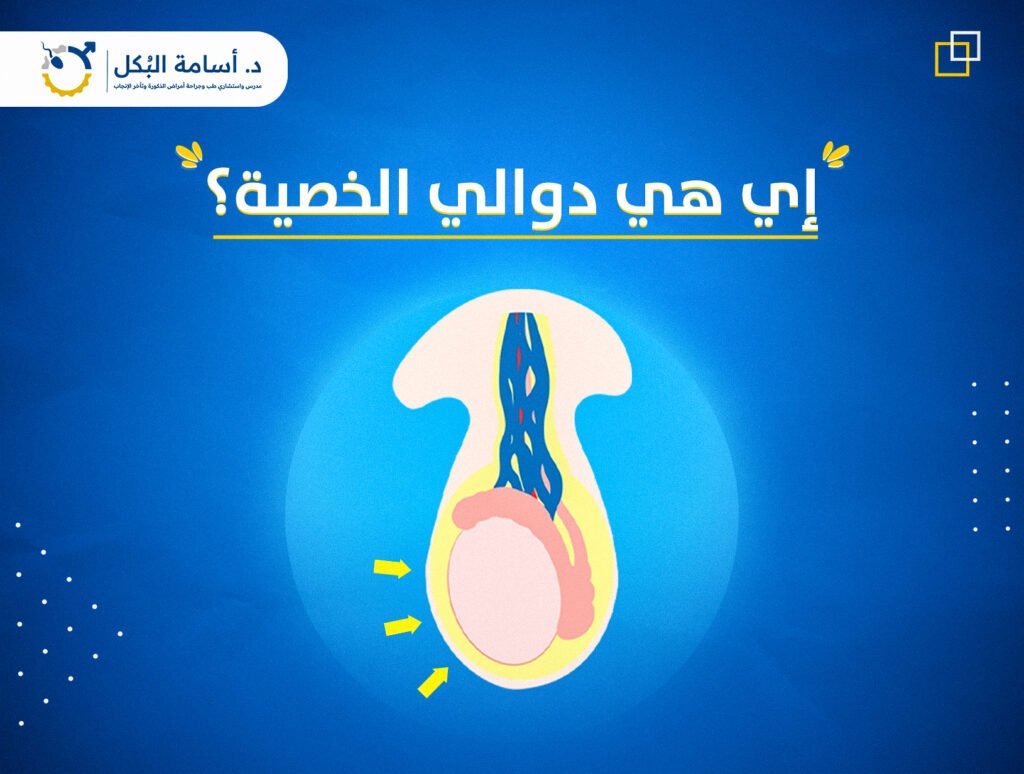 أي هي دوالي الخصية المسؤولة عن تأخر الإنجاب