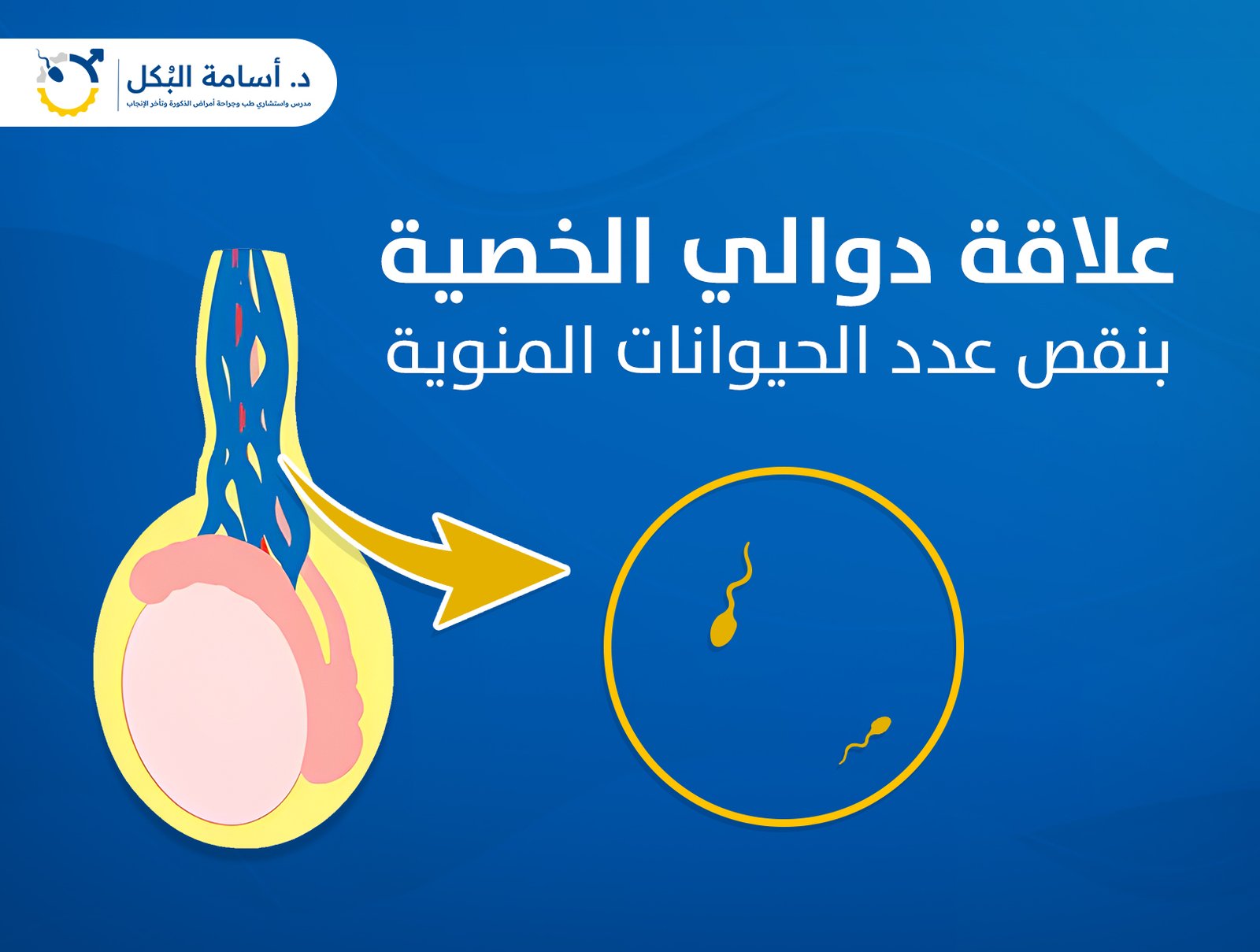 هل دوالي الخصية بتسبب نقص في عدد الحيوانات المنوية ؟